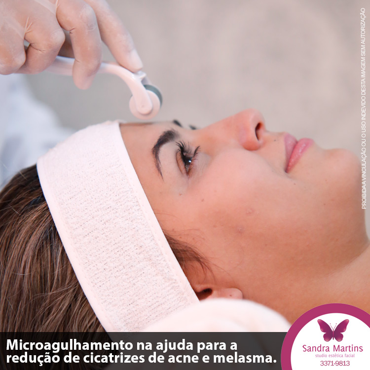 O Microagulhamento Para Cicatrizes De Acne E Melasma Taguatinga