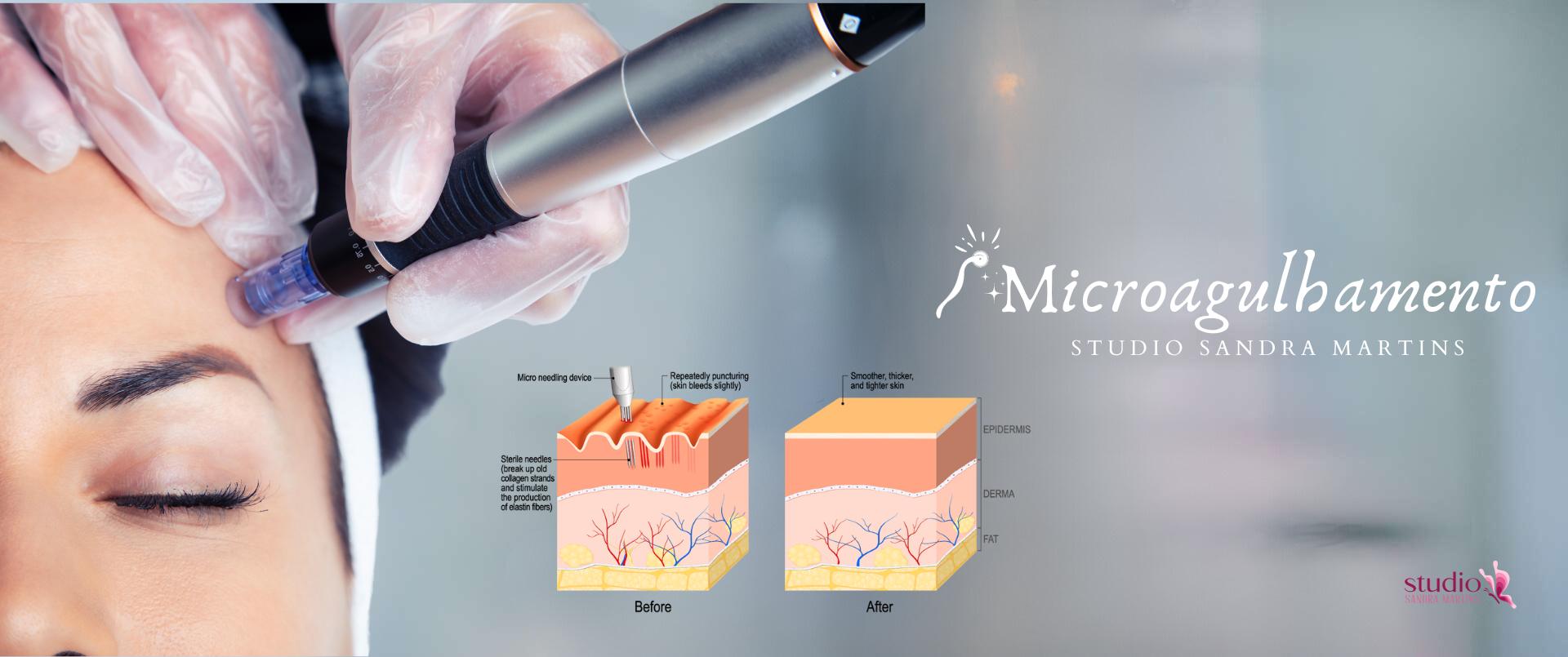 O Dermapen é um dispositivo elétrico com agulhas finas que vibram, criando microperfurações na pele de forma precisa e controlada. Essa técnica, conhecida como microagulhamento com Dermapen, é uma das mais modernas e eficazes para estimular a produção de colágeno e elastina, promovendo a renovação da pele e a redução de diversas imperfeições.