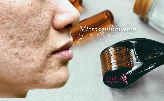 Microagulhamento: Para uma Pele Radiante em Taguatinga