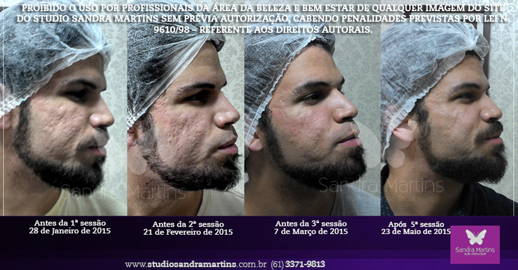 Microagulhamento contra cicatriz marca e mancha de acne brasilia sandra martins