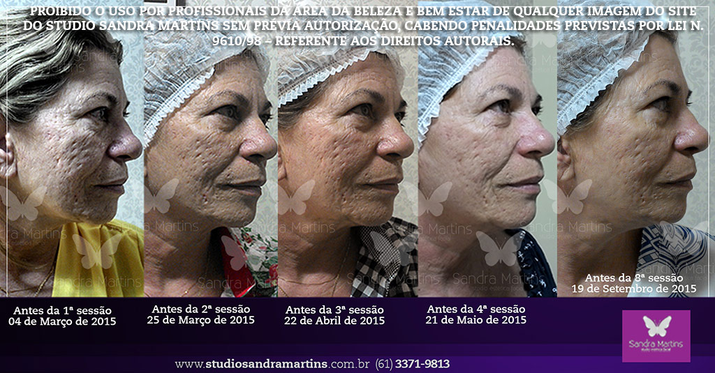 Microagulhamento contra cicatriz marca e mancha de acne brasilia sandra martins