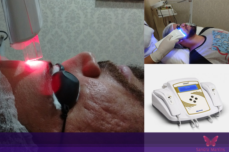 laserterapia e microagulhamento facial brasilia sandra martins taguatinga