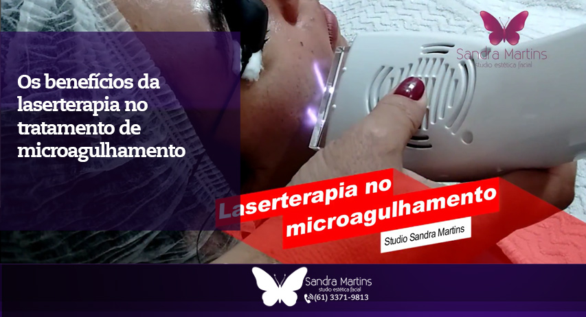 Você ainda não sabe o que é o microagulhamento? Conheça o tratamento e o benefício da laserterapia contra as cicatrizes de acne em Brasília.