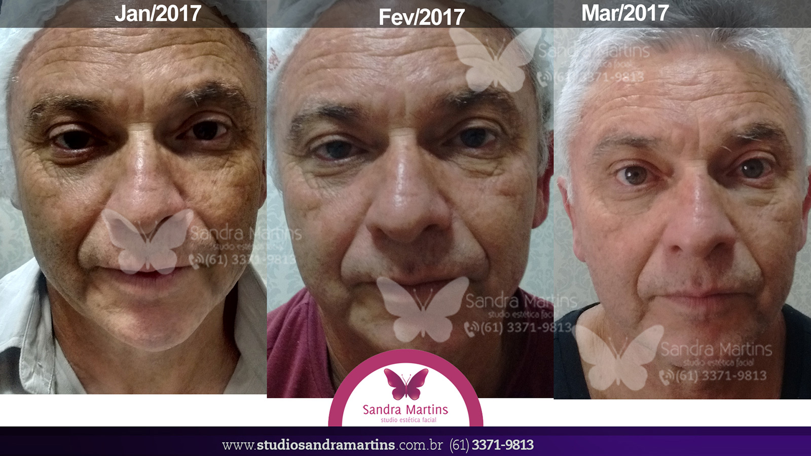 Antes e depois do tratamento de Peeling Criogênico