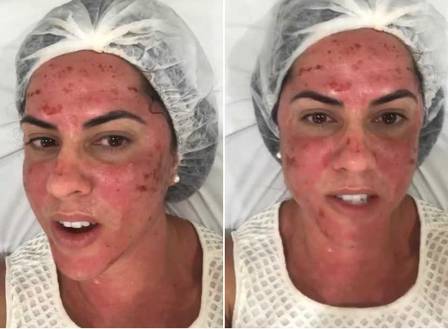 Não é de hoje que personalidades e atrizes aderiram ao tratamento de microagulhamento para melhorar a textura da pele do rosto em Brasília