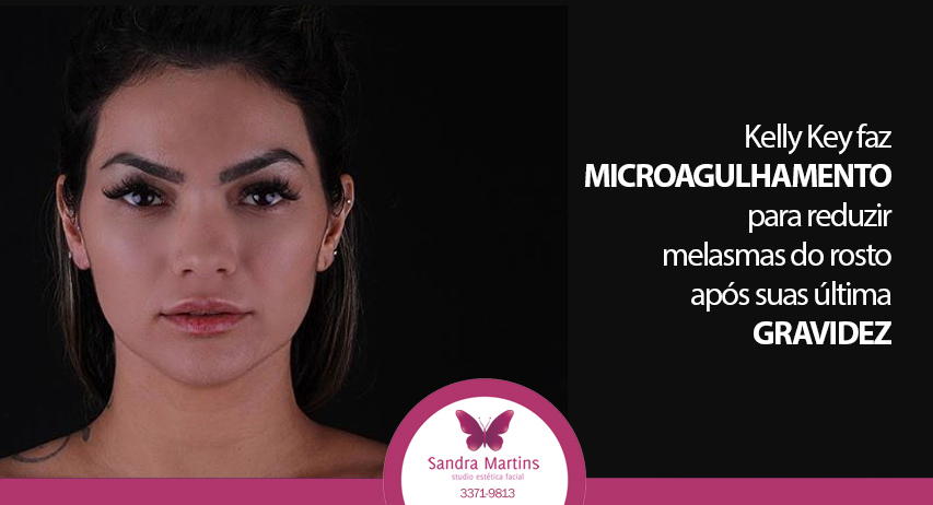 A cantora Kelly Key optou pelo microagulhamento para reduzir melasmas do rosto! Mesmo tratamento já realizado aqui a mais de 4 anos em Brasília.