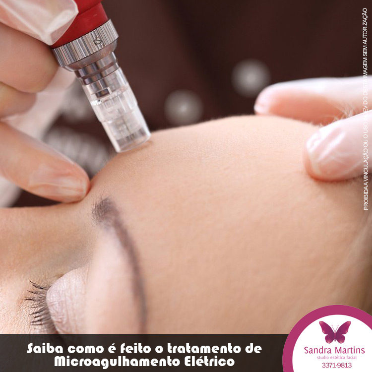 Conheça os benefícios reais do microagulhamento elétrico com Dermapen para sua pele. Onde os tratamentos faciais e dermocosméticos são sempre uma boa opção para quem quer se manter sempre com o rosto jovem.