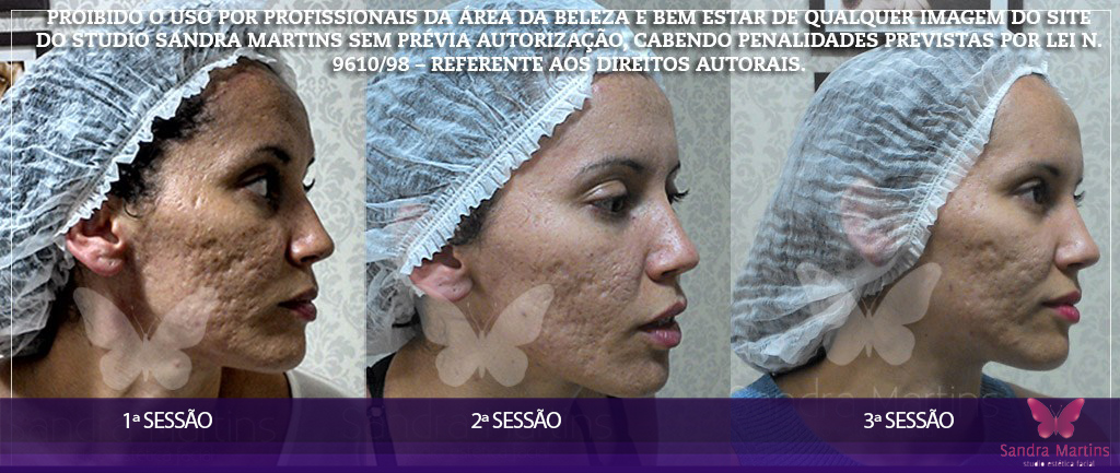 antes e depois clareamento, limpeza de pele, microagulhamento, dermaroller e rejuvenescimento Brasilia Sandra Martins