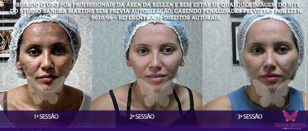 antes e depois clareamento, limpeza de pele, microagulhamento, dermaroller e rejuvenescimento Brasilia Sandra Martins