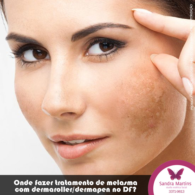 O Melasma se caracteriza por manchas escuras na pele, geralmente na face, mas que também podem aparecer em outras partes do corpo, como colo, braços e pescoço. Sua incidência é mais comum em mulheres entre os 20 e 50 anos, porém também pode afetar os homens