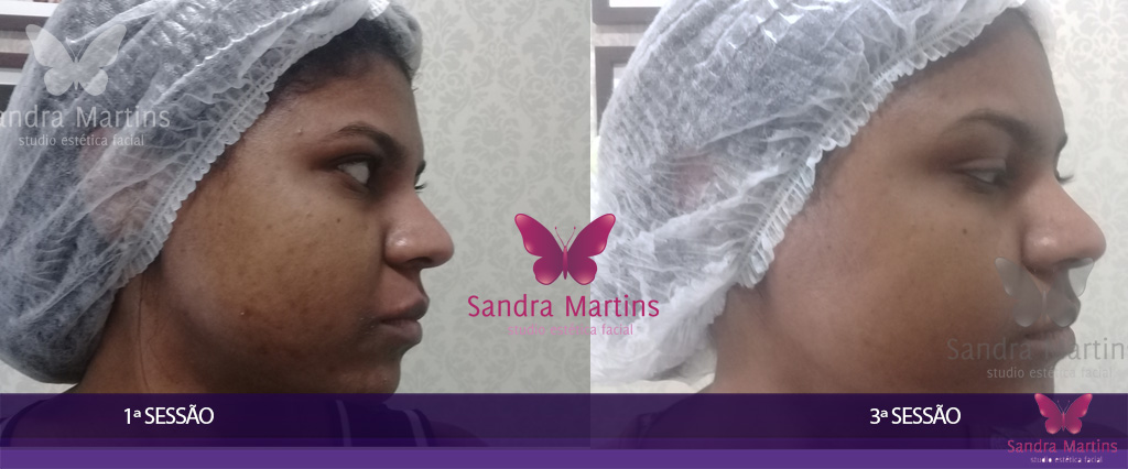 O mais moderno e eficiente tratamento de clareamento e rejuvenescimento facial: Vulcan Ice Max o Peeling das Estrelas com Ácidos Vulcânicos em Taguatinga.