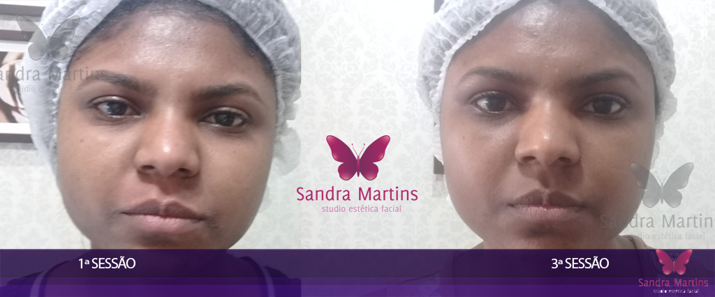 O mais moderno e eficiente tratamento de clareamento e rejuvenescimento facial: Vulcan Ice Max o Peeling das Estrelas com Ácidos Vulcânicos em Taguatinga.