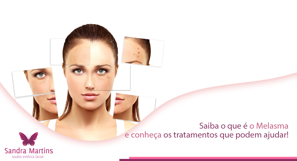 Você mora em Brasília ou regiões? Então saiba o que é melasma e os principais tratamentos realizados no Studio Sandra Martins que fica em Taguatinga.