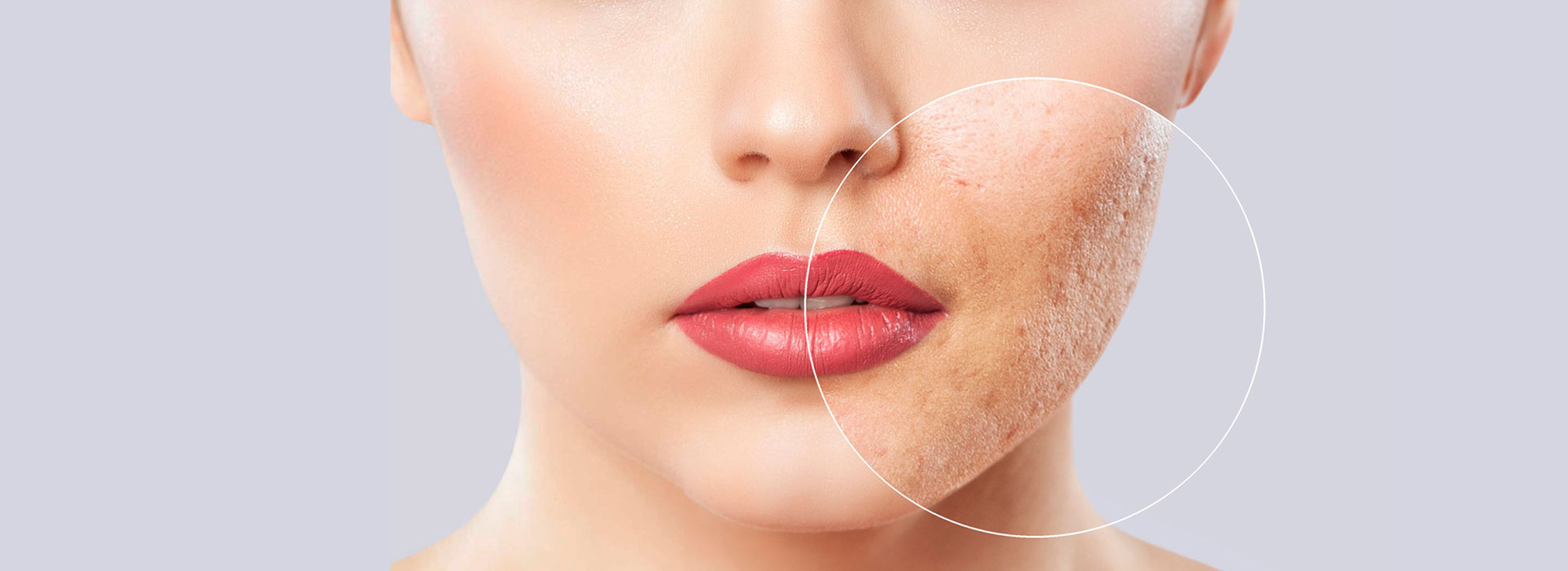Microagulhamento para cicatriz de acne maio 19, 2022 Studio Sandra Martins de Estética Facial Os melhores tratamentos estética facial: limpeza de pele, cicatriz de acne, melasma, manchas, harmonização papada, pescoço e colo em Brasília