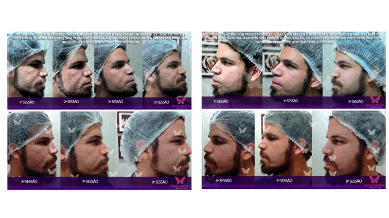Microneedling: o método inovador para tratar cicatrizes, manchas e rejuvenescimento facial maio 3, 2024 Studio Sandra Martins de Estética Facial