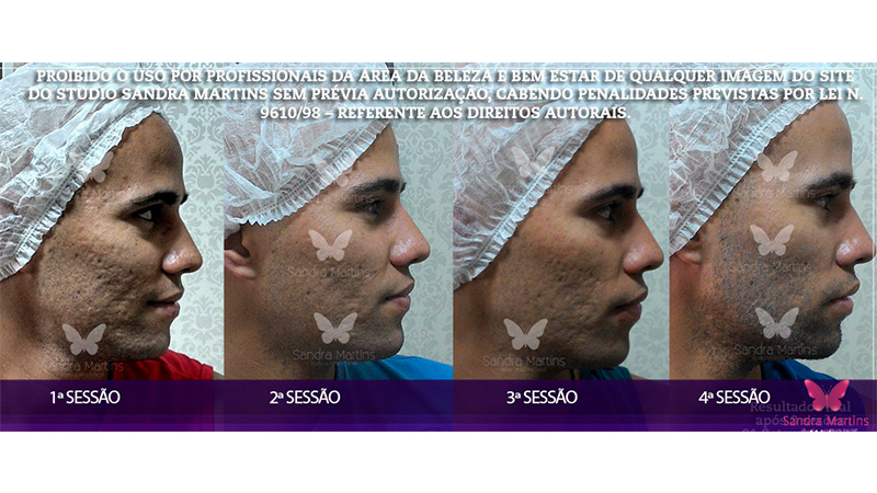 Por que o microagulhamento é o melhor tratamento para a pele do rosto? abril 27, 2024 Studio Sandra Martins de Estética Facial