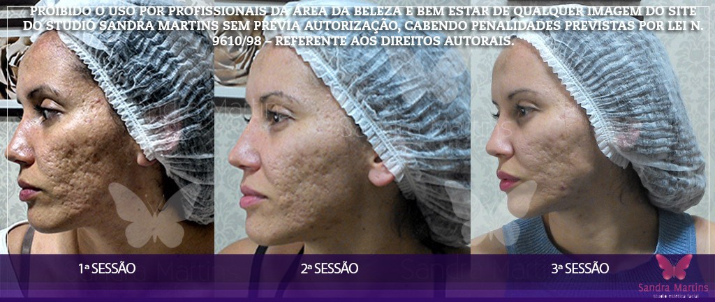 antes-e-depois-microagulhamento-brasilia-cicatriz-furinhos-manchas-acne