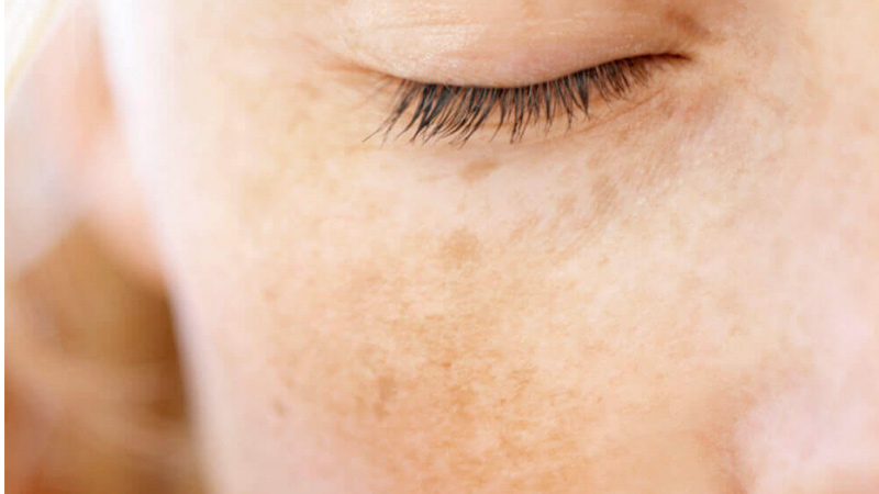 Se você está procurando o melhor tratamento de clareamento de manchas de melasma em Taguatinga, você veio ao lugar certo! O Studio Sandra Martins oferece um blend de ácidos poderoso e eficaz para clarear as manchas de melasma e uniformizar a tonalidade da pele.