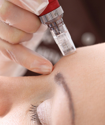 Microagulhamento com dermapen para cicatriz de acne maio 24, 2022 Studio Sandra Martins de Estética Facial Microagulhamento com dermapen para cicatriz de acne maio 24, 2022 Studio Sandra Martins de Estética Facial