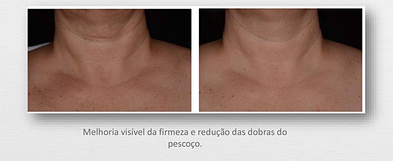 Conheça o revolucionário tratamento estético facial de microagulhamento para harmonização de papada e de lifting de pescoço e colo do Studio Sandra Martins em Brasília