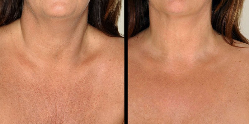 5 benefícios do microagulhamento feito em Taguatinga para a sua pele maio 2, 2024 Studio Sandra Martins de Estética Facial
