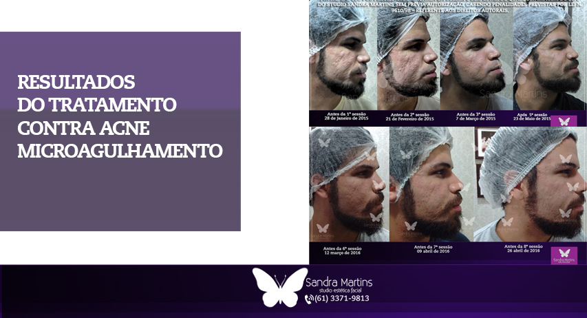 Confira 5 benefícios do microagulhamento feito em Brasília para a sua pele: marcas de acne, poros abertos, harmonização facial sem corte e muito mais! 