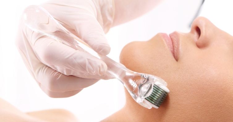 Este tratamento, Microneedling ou Microagulhamento, que perfura a pele pode ser um pouco invasivo, mas tem resultados que há muito tempo se procuravam.
