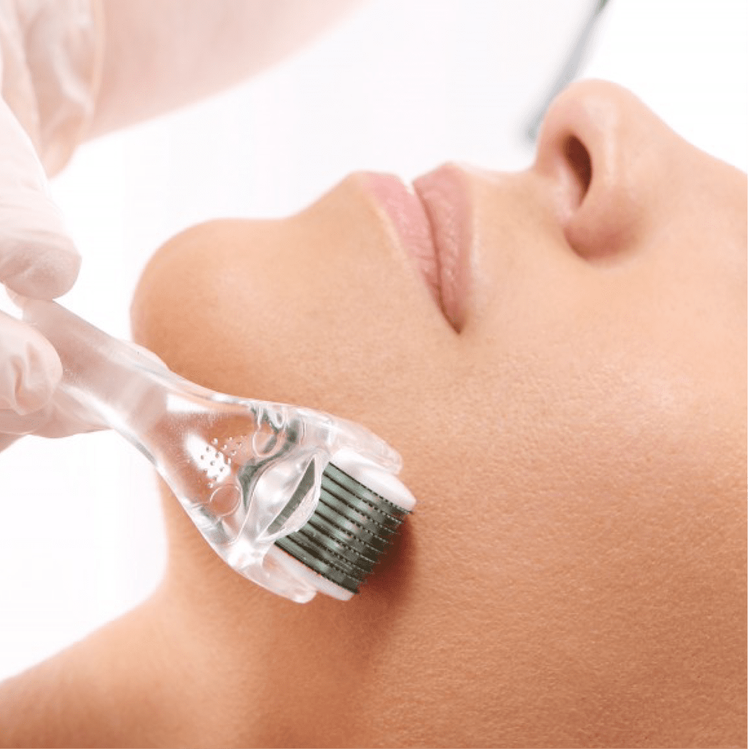 Durante a pandemia em Brasília o Microagulhamento é um dos tratamentos mais procurados! Saiba como funciona essa técnica para a pele