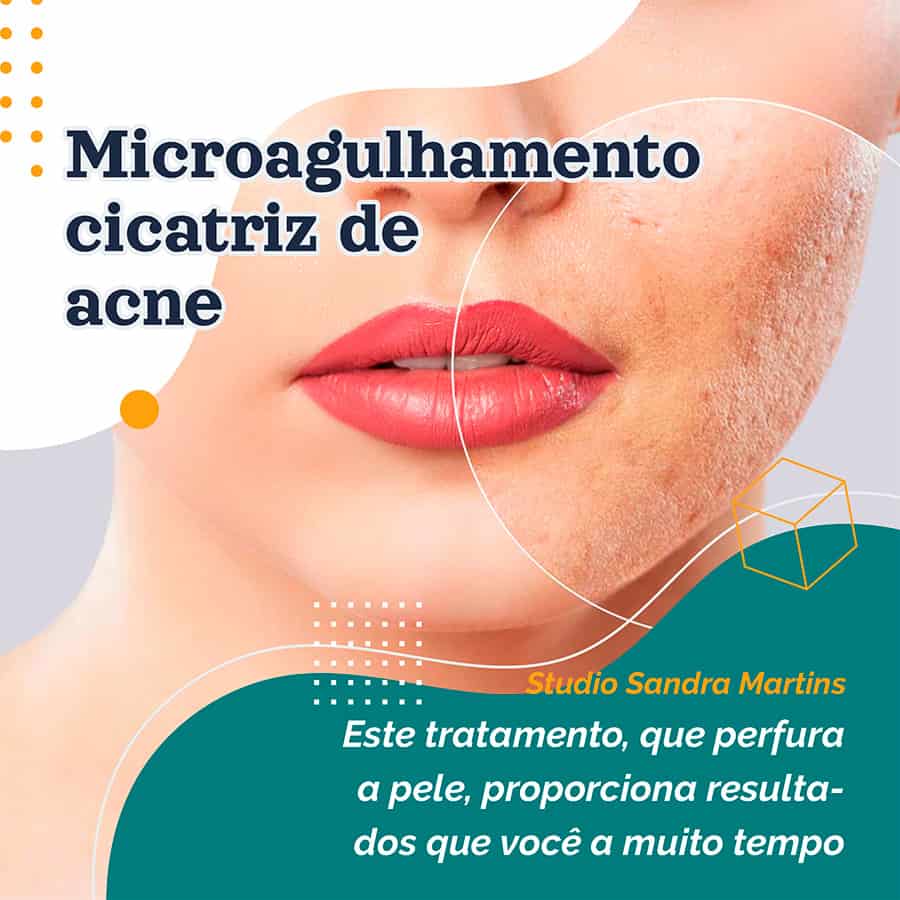Chama-se microneedling — ou microagulhamento, em português — e promete melhorar o aspeto das rugas, reduzir manchas, marcas de acne ou outras cicatrizes, e até pode ajudar a estimular a Harmonização da papada, pescoço e colo