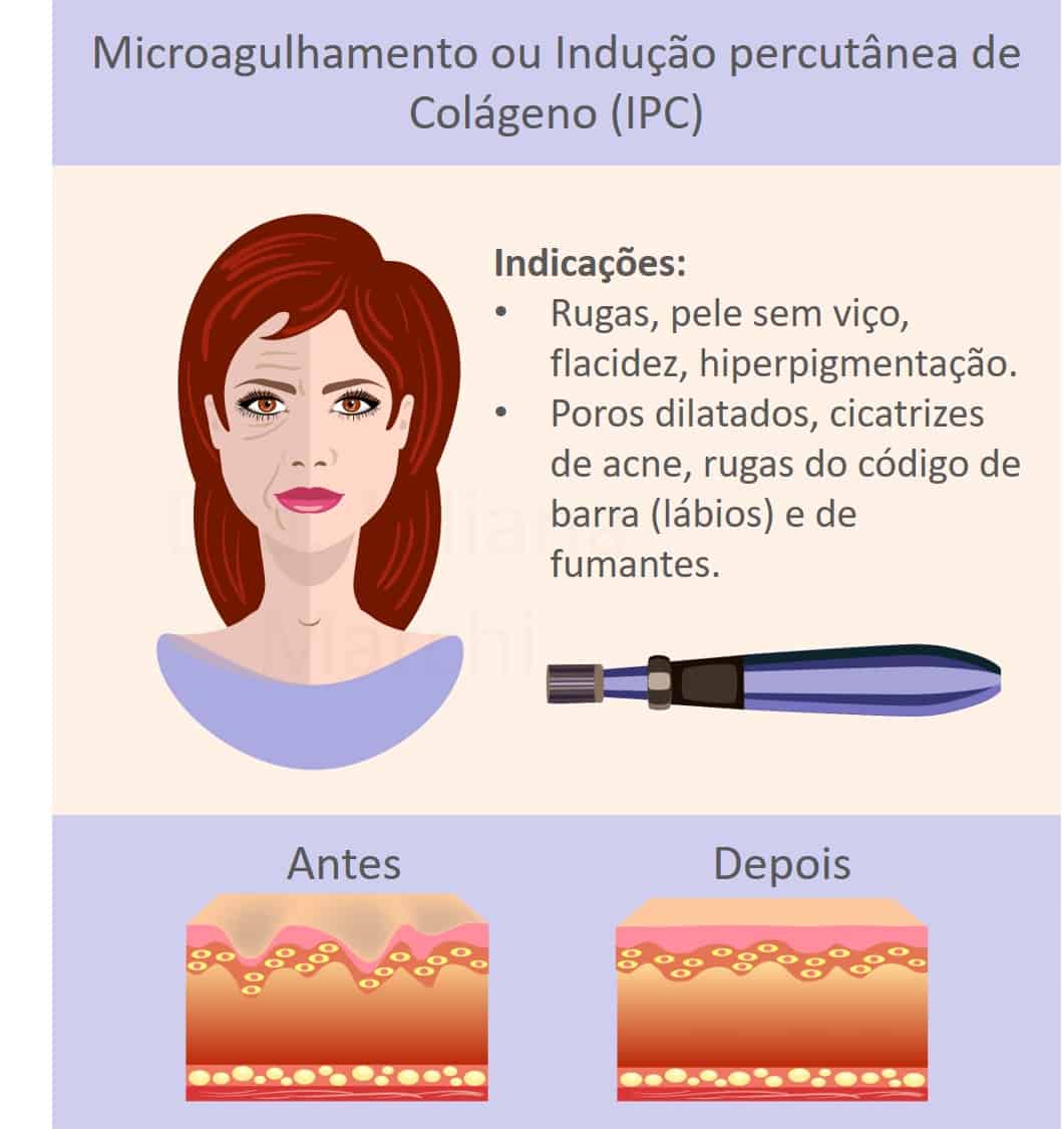 Microagulhamento como funciona a técnica que melhora a aparência da pele abril 26, 2024 Studio Sandra Martins de Estética Facial