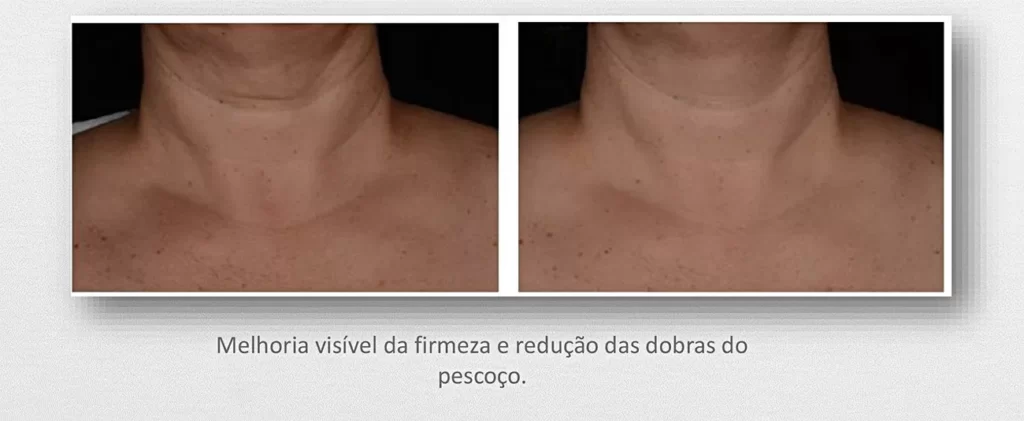 Os melhores tratamentos ESTÉTICA FACIAL de Brasília: microagulhamento, limpeza de pele, melasma, clareamento de manchas e harmonização no DF