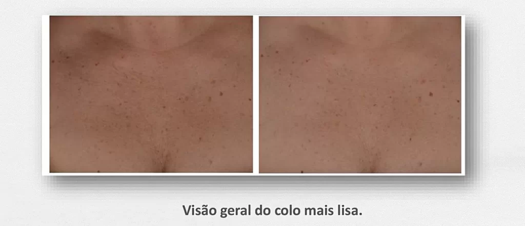 Microagulhamento antes e depois maio 3, 2024 Studio Sandra Martins de Estética Facial