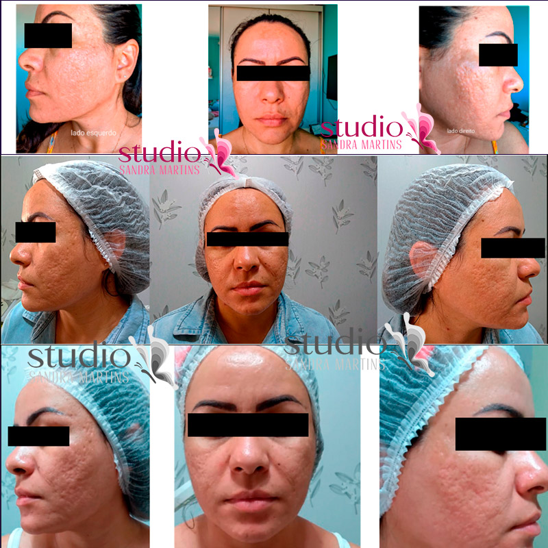 antes e depois microagulhamento cicatriz de acne Studio Sandra Martins Estética Facial em Brasília