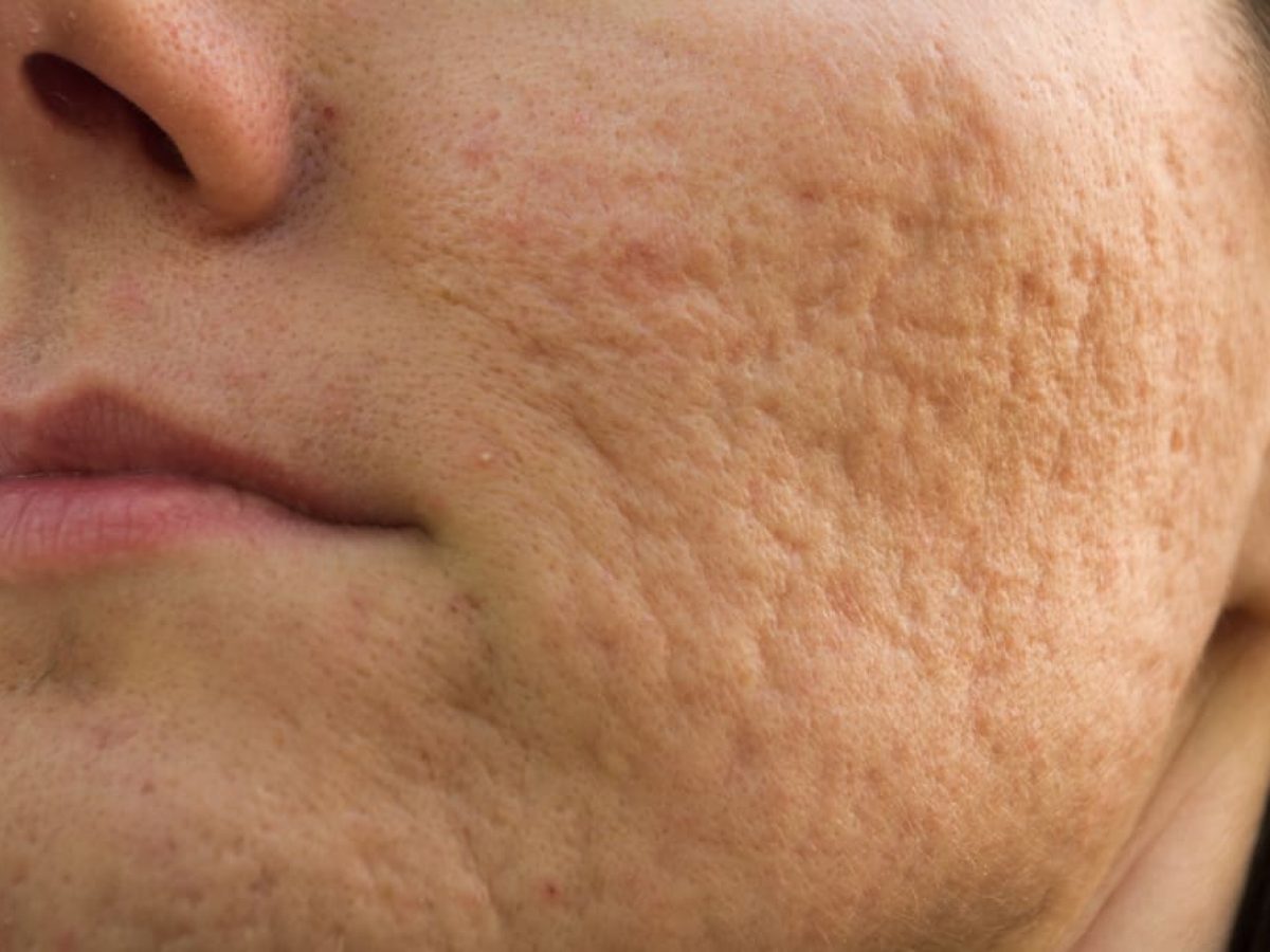 O Melhor Tratamento Para Cicatriz De Acne Em Bras Lia