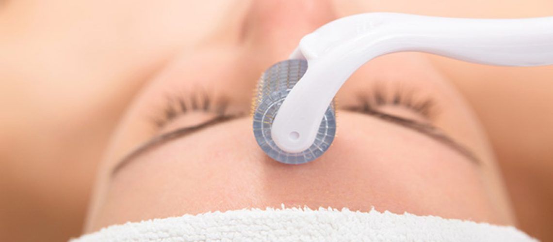 O microagulhamento também é conhecido como indução percutânea de colágeno por agulhas (IPCA). O procedimento baseia-se em diversas agulhas que perfuram as camadas da pele, causando micro ferimentos e vermelhidão, estimulando naturalmente a regeneração da pele com o colágeno.