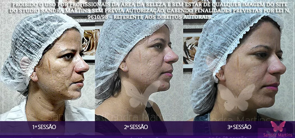 Benefícios do microagulhamento para a pele do rosto em Taguatinga maio 2, 2024 Studio Sandra Martins de Estética Facial
