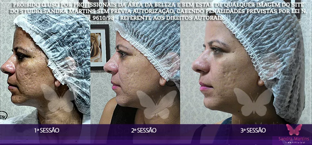 Benefícios do microagulhamento para a pele do rosto em Taguatinga maio 2, 2024 Studio Sandra Martins de Estética Facial