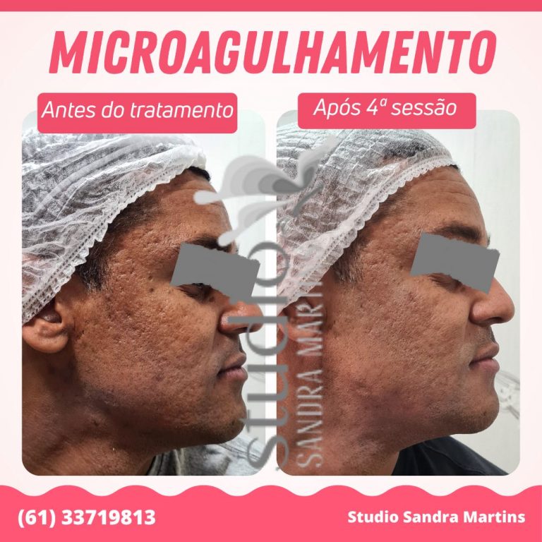 Microagulhamento para que serve Sandra Martins Taguatinga Estética Facial