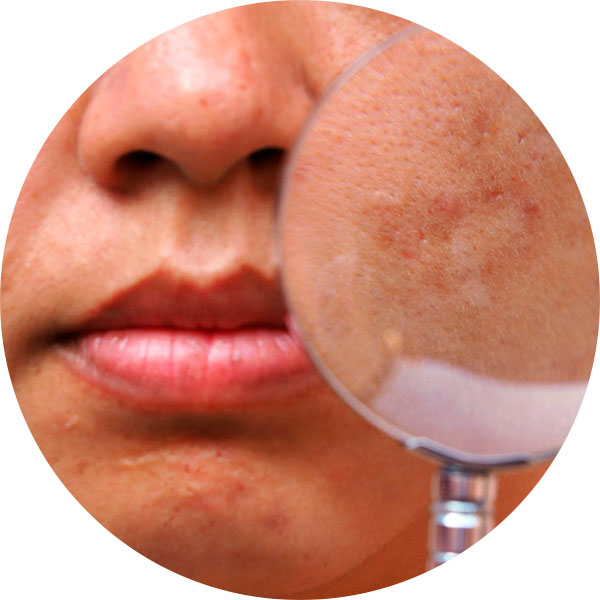 Microagulhamento para cicatriz de acne junho 15, 2022 Studio Sandra Martins de Estética Facial