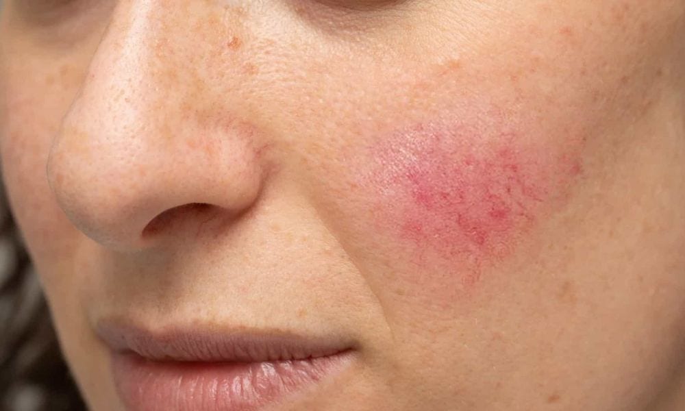 A pele sensível pode se dar por diversos fatores desde dermatite por contato até a atópica, presença da rosácea ou até mesmo uma pele que é apenas intolerante a alguns ativos por irritabilidade.