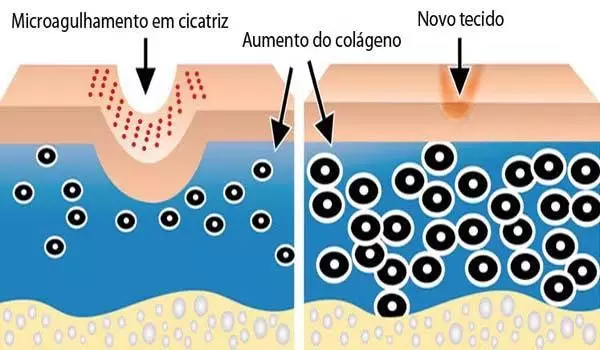Bioestimulação de colágeno é um tratamento realizado por meio do microagulhamento, como diz o nome, estimulam a produção do colágeno na sua pele.