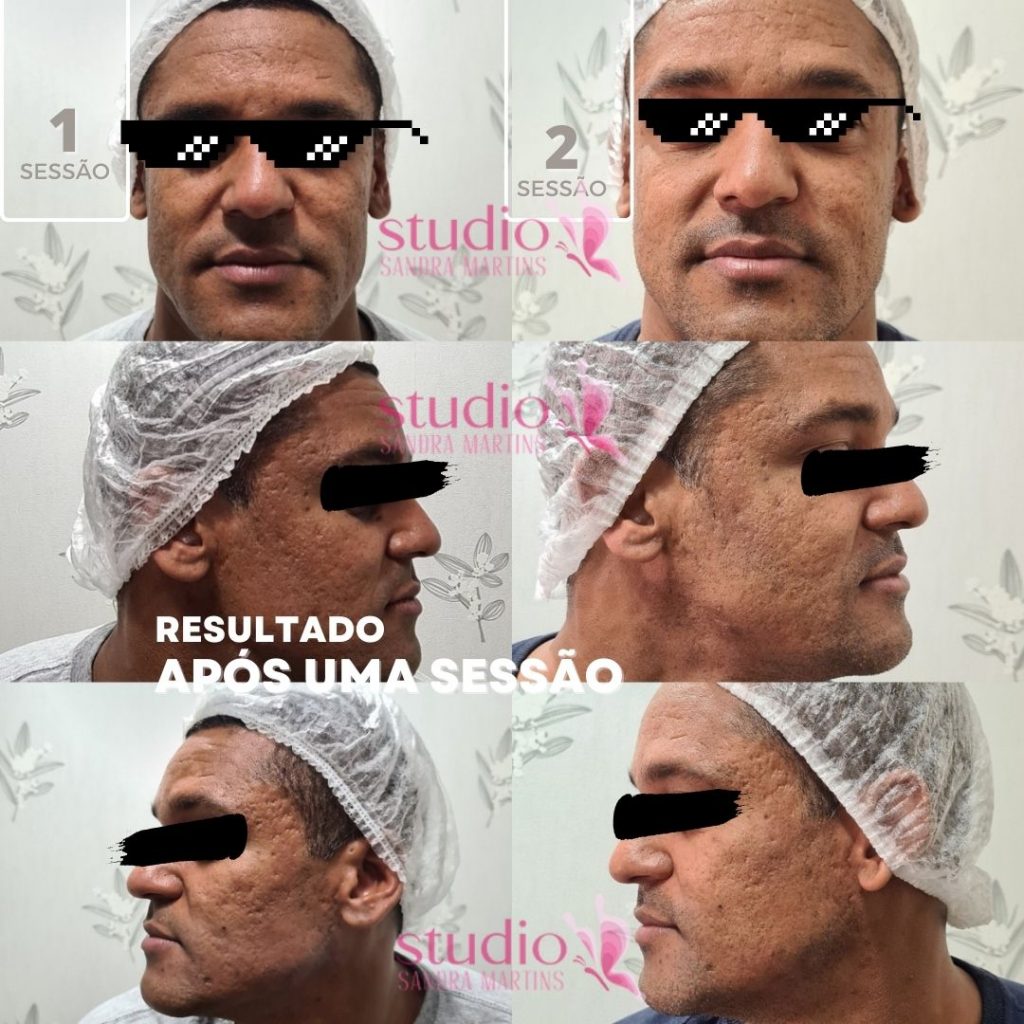 Microagulhamento antes e depois 1 sessão tem resultados em Brasília