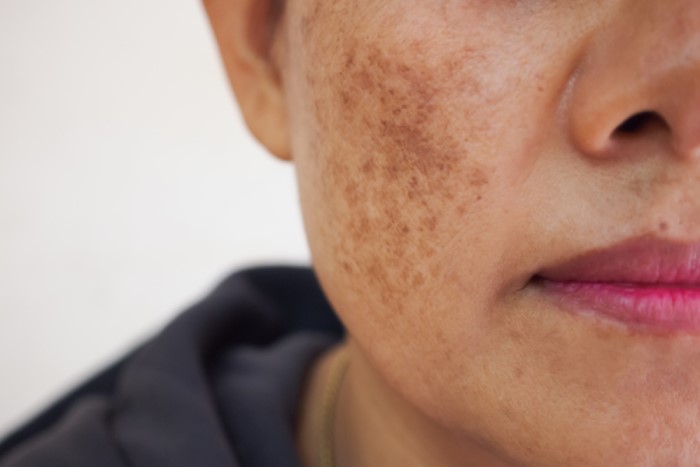 Você que mora em Brasília já deve ter se perguntado: qual é o melhor tratamento de mancha de melasma para sua pele! Recomendamos o Studio Sandra Martins em Taguatinga.