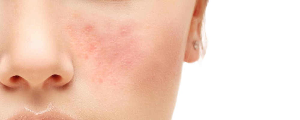 Todo mundo quer uma pele bonita, isso é inegável. Esse texto vai falar sobre o tratamento com retinóide, o que são e como usar os produtos para tratar a acne da pele.