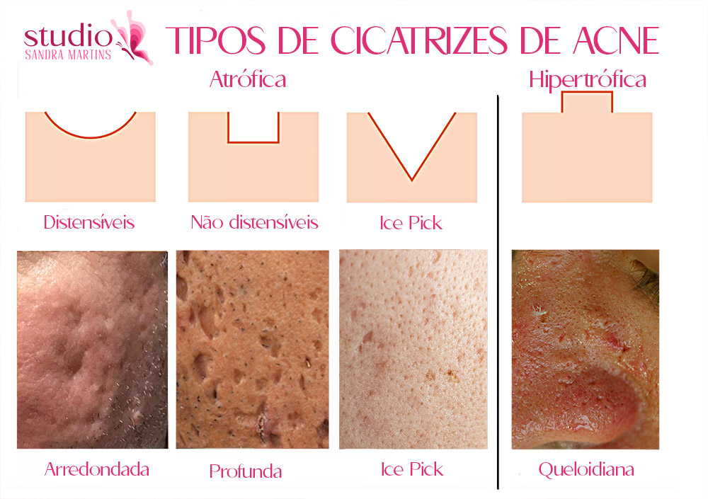 Microagulhamento para tratamento da cicatriz de acne em Brasília. Quase todas as pessoas já tiveram acne ao longo da vida, principalmente, durante a puberdade.