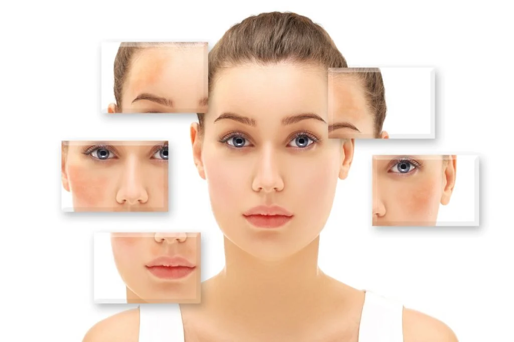 Secar o cabelo e cozinhar piora manchas de melasma - Sandra Martins Estética Facial em Taguatinga