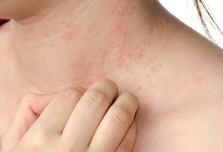 Pesquisa de opinião, sobre a dermatite, encomendada pela Pfizer mostra que ainda há muita desinformação sobre a condição dermatológica 