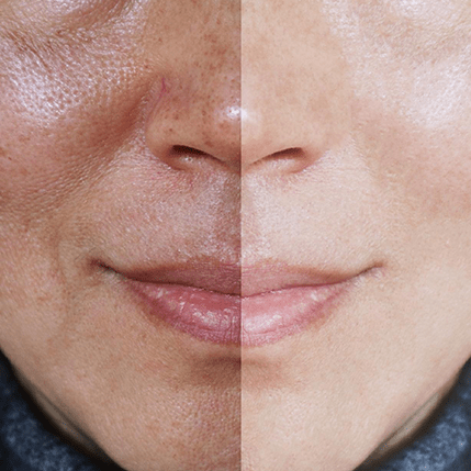 Melhor tratamento melasma e mancha em Taguatinga maio 11, 2024 Studio Sandra Martins de Estética Facial