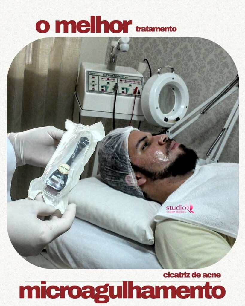 Se você chegou aqui é porque com certeza está procurando o valor do microagulhamento de R$100,00!