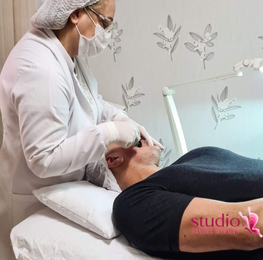 Quantas sessões são necessárias de microagulhamento para diminuir os furinhos no rosto causados pelas cicatrizes de acne